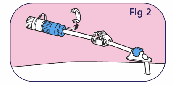 Fixation of the outer retaining device and rest: Courtesy Fresenius Kabi