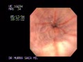 The severity of erosive oesophagitis on endoscopy is usually graded using the Los Angeles classification:
Grade A- One or more mucosal breaks no longer than 5 mm, none of which extends between the tops of the mucosal folds
Grade B- One or more mucosal breaks more than 5 mm long, none of which extends between the tops of two mucosal folds
Grade C- Mucosal breaks that extend between the tops of two or more mucosal folds, but which involve less than 75% of the oesophageal circumference
Grade D-Mucosal breaks which involve at least 75% of the oesophageal circumference
Courtesy: www.gastrointestinalatlas.com
