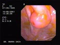 Inverted appendicular stump post appendicectomy- may resemble a polyp- Beware!
Courtesy: www.gastrointestinalatlas.com