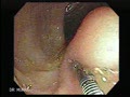 A mobile mass that is soft and indents when depressed using biopsy forceps (pillow sign) is highly suggestive of a lipoma. 
Courtesy: www.gastrointestinalatlas.com