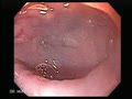 Mid Oesophageal Diverticulum
