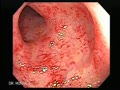 Radiation injury is due to progressive fibrosis associated with obliterative endarteritis and chronic mucosal ischemia.  Endoscopy reveals pale and friable mucosa with telangiectasias. The changes could be continuous or patchy.  
Courtesy: www.gastrointestinalatlas.com
