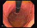 Normal Gastric fundus