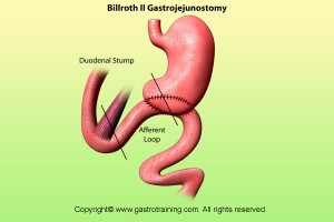 Billroth II surgery