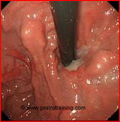 Gastric varices