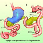 Roux en Y gastric bypass