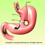 Vertical banded Gastroplasty (VBG)