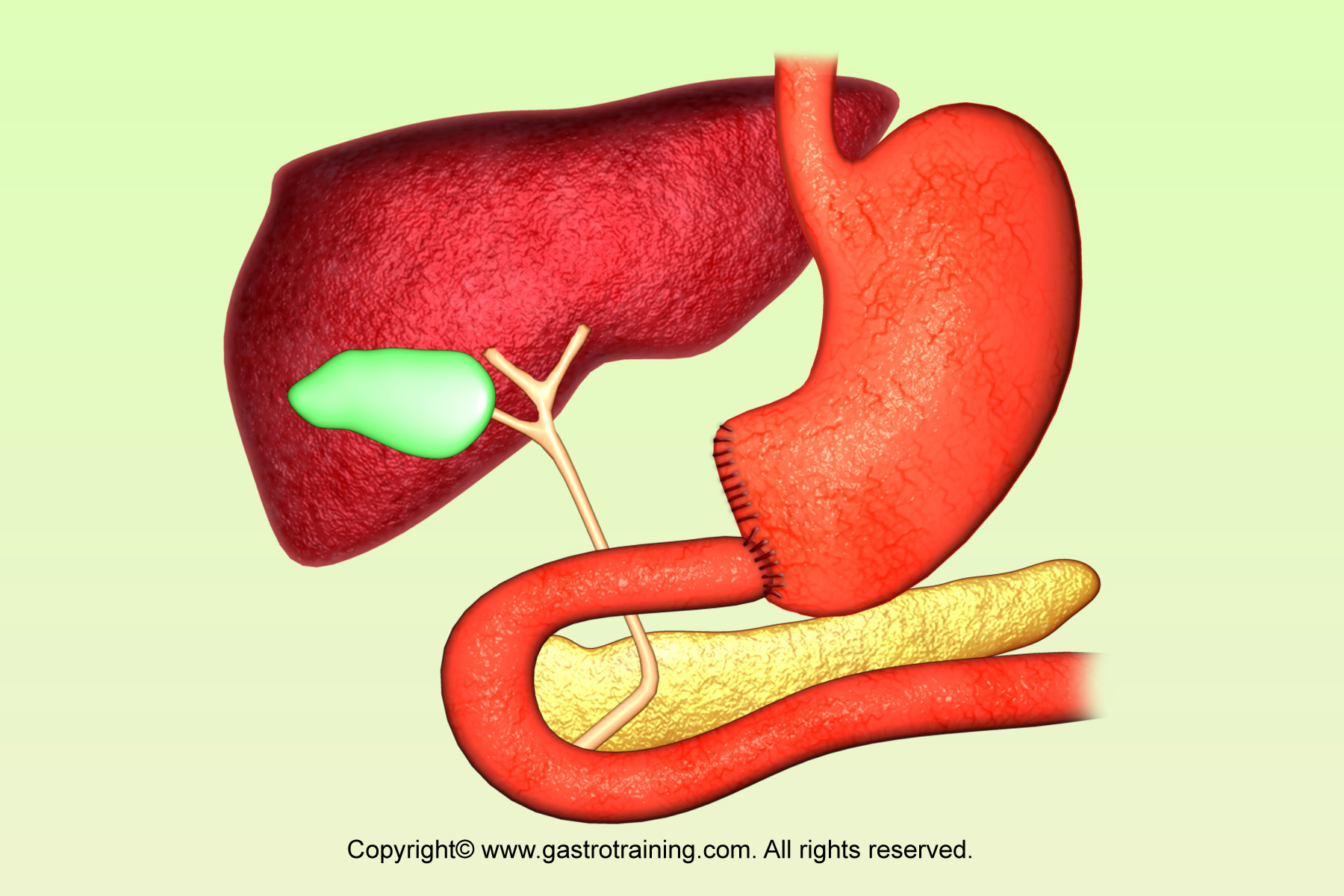 Резекция желудка анемия