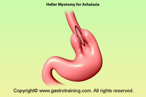 Heller's myotomy