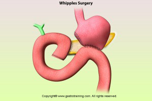 Whipple's surgery