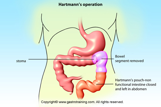 Hartmann's Operation