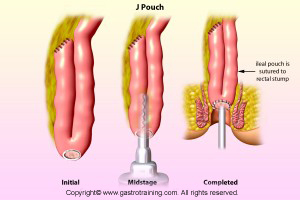 J pouch for colitis