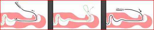 reka NJT going through the biopsy channel and the endoscope being removed subsequently keeping the NJT in :Courtesy Fresenius Kabi