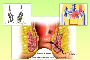 Seton insertion for fistula