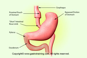 Bypass surgery for obesity