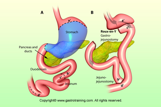 Roux-en-Y-anastomosis