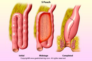 S pouch for colitis