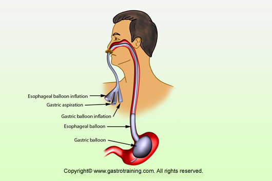 Sengstaken-Blakemore tube