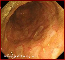 Pic 1 Colonic ulcers in Crohn’s disease