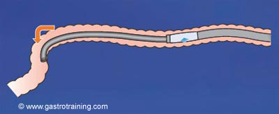 Insert the scope as deep as possible into the small bowel and fix the angulation of the scope