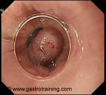 One oesophageal varix banded successfully