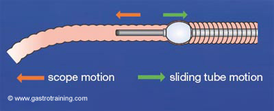 Withdraw the overtube and if possible, try to push the endoscope simultaneously