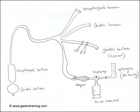 The setting up of Modified Sengstaken-Blakemore tube</ins>