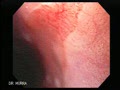 Barrett's Oesophagus