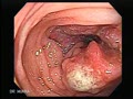 Colon cancer