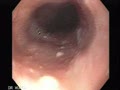 Oesophageal Candididiasis