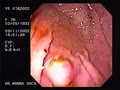 Dieulafoy lesion