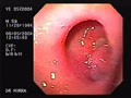 Duodenal Ulcer