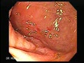 Gastrointestinal Stromal tumour (GIST)