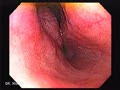 Oesophageal GIST 