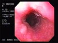 These lesions appear as multiple uniformly sized oval or round grey-white plaques usually 2-10 mm in diameter. For more details, please visit Learning Modules section
Courtesy: www.gastrointestinalatlas.com