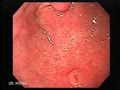 Usually incidental findings but may cause ulceration, obstruction, intussusception.
Courtesy: www.gastrointestinalatlas.com