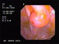 Inverted appendicular stump 