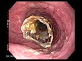 Oesophageal stent in situ