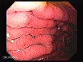Portal Hypertensive Gastropathy