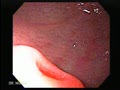 It is usually an incidental finding but may cause ulceration, obstruction and intussusception.
Courtesy: www.gastrointestinalatlas.com