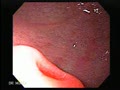 It is usually an incidental finding but may cause ulceration, obstruction and intussusception.
Courtesy: www.gastrointestinalatlas.com