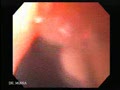 Para oesophageal hernia