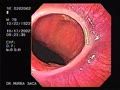 Schatzki ring is a lower oesophageal mucosal ring that causes intermittent dysphagia. Most investigators believe that it is caused by scarring from reflux oesophagitis.
Courtesy: www.gastrointestinalatlas.com