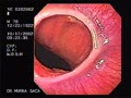 Schatzki ring is a lower oesophageal mucosal ring that causes intermittent dysphagia. Most investigators believe that it is caused by scarring from reflux oesophagitis.
Courtesy: www.gastrointestinalatlas.com