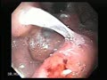 Gastric varices