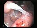 Gastric varices