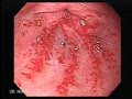 Gastric Antral Vascular Ectasia (GAVE)- also known as watermelon stomach
Courtesy: www.gastrointestinalatlas.com