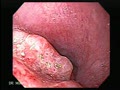 Gastric cancer 