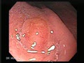 They have a white, yellow or gray appearance that can be observed through the intact mucosa. The yellow colour is a result of cholesterol and lipid accumulation within the tumour. 
Courtesy: www.gastrointestinalatlas.com 