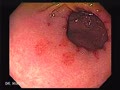 Erosive gastritis